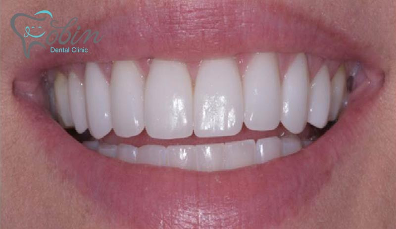 پس از اتمام کامپوزیت دندانپزشک پرتوی نوری را روی دندان منعکس می نماید